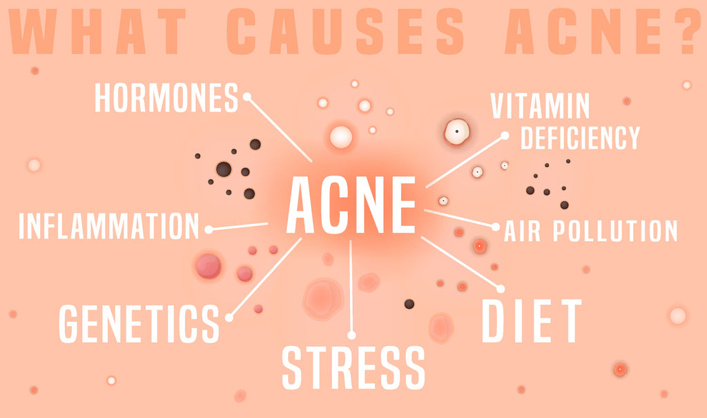 What Are The Types of Acne and How To Treat Them