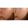 Acne Scar Removal Treatment Cream