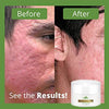 Acne Scar Removal Treatment Cream