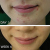 Acne Scar Removal Treatment Cream