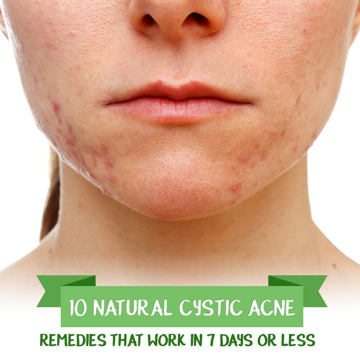 10 Natural Cystic Acne Remedies that Work in 7 Days or Less
