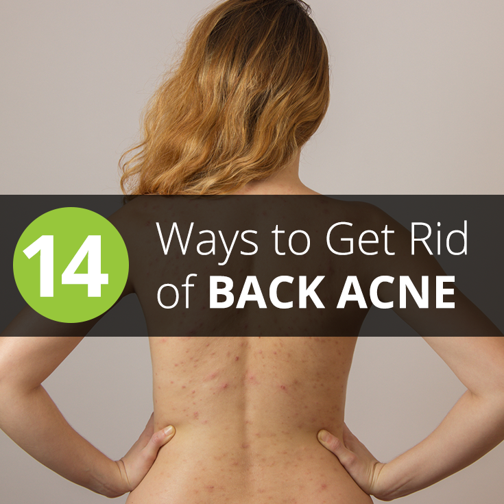 14 Ways to Get Rid of Back Acne (Bacne) At Home in 20 Minutes or Less