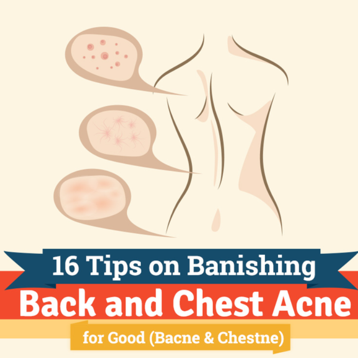 16 Tips on Banishing Back and Chest Acne for Good (Bacne & Chestne)