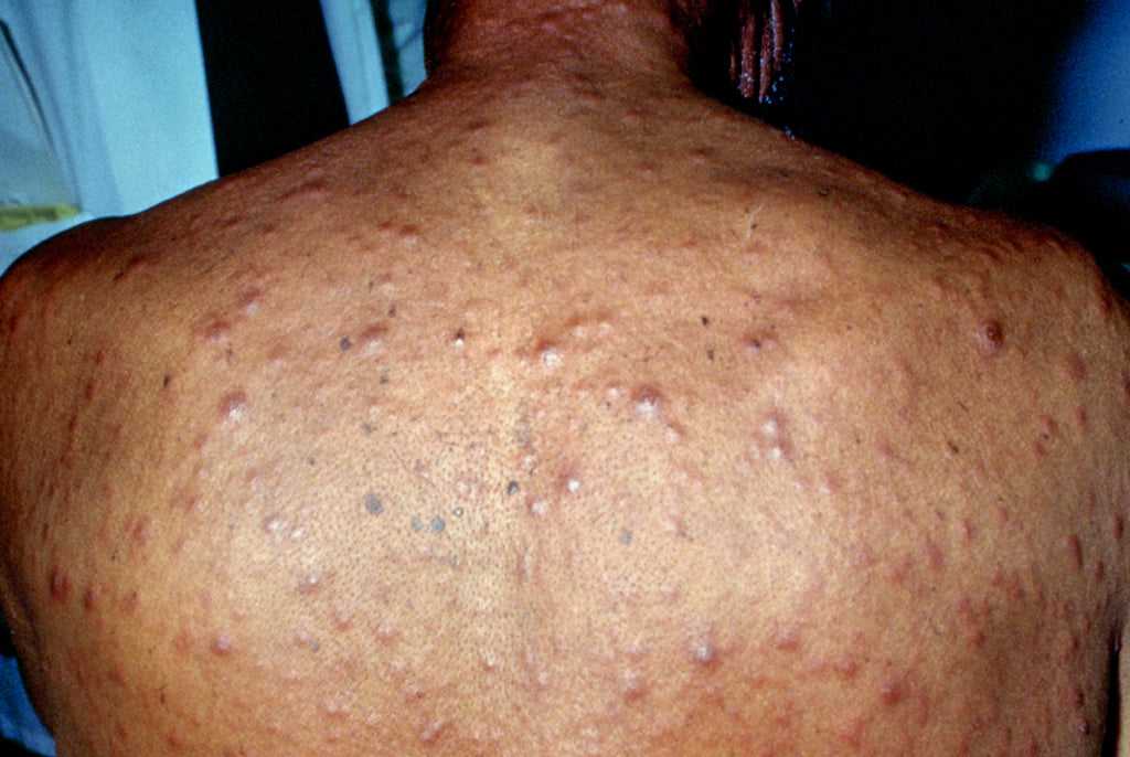 How To Treat Back Acne?