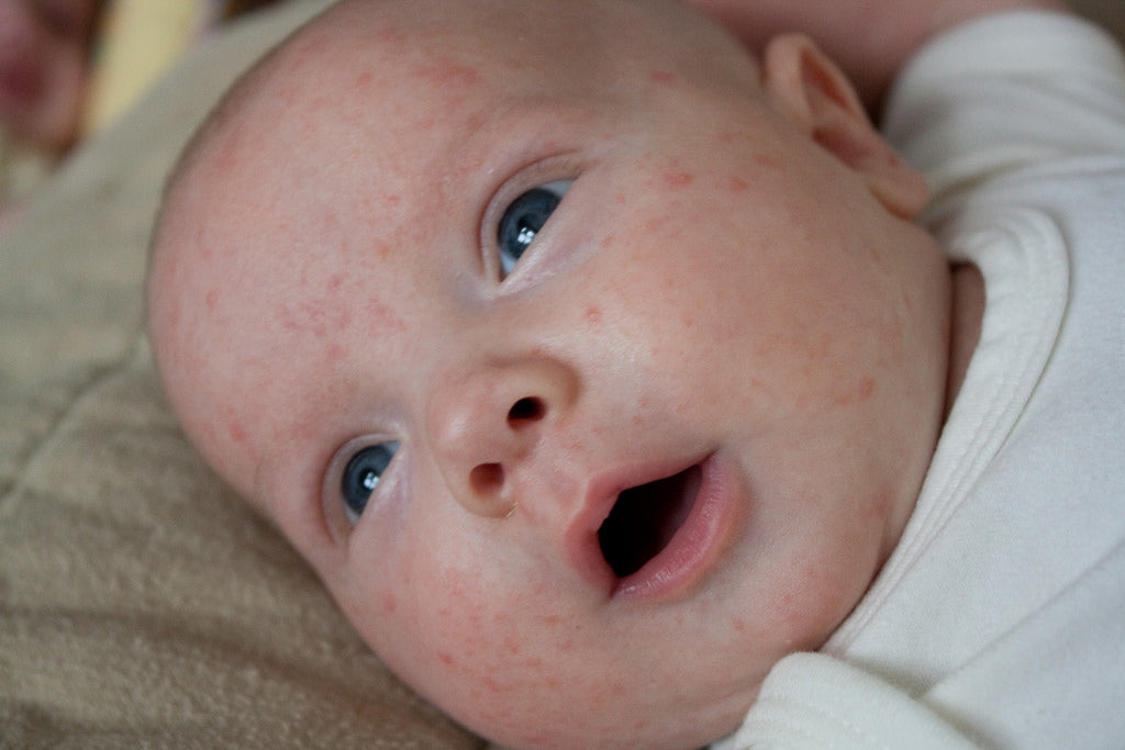 How Long Does Baby Acne Last?