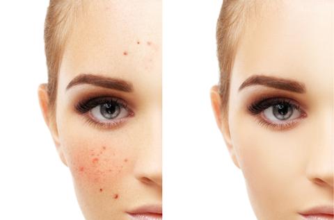 How To Clear Up Acne?