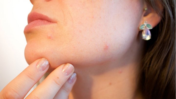 How To Get Rid Of Acne Redness?