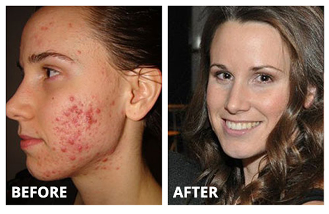 How To Get Rid Of Red Acne Scars?