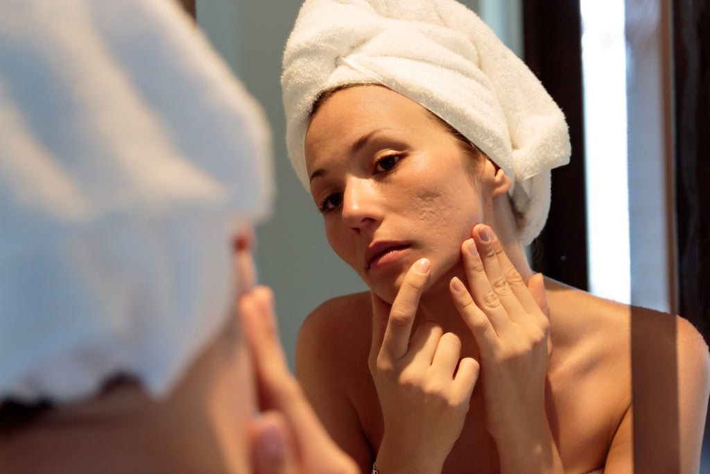 Can acne scars go away?