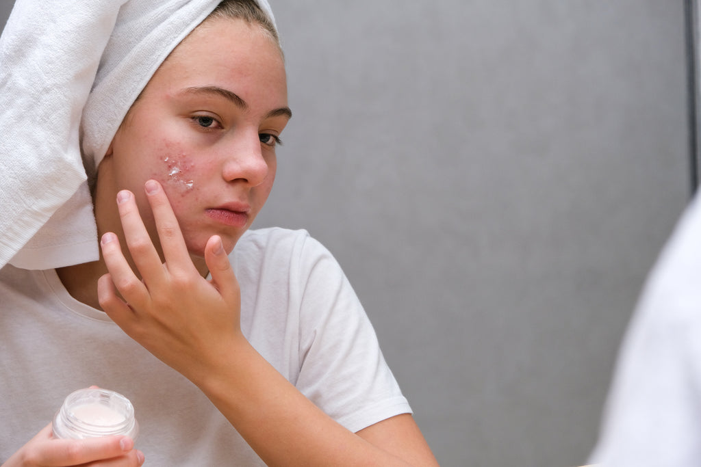 Types of Acne Scars & How To Heal Them