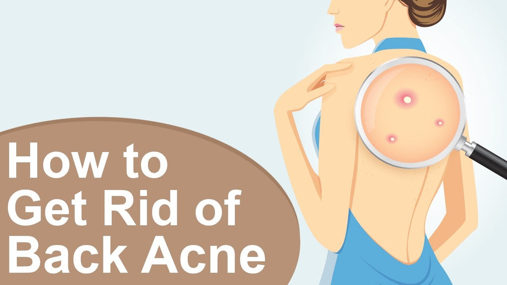How To Get Rid of Back Acne in A Day?