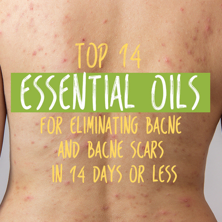 Top 14 Essential Oils for Eliminating Bacne and Bacne Scars in 14 Days or Less